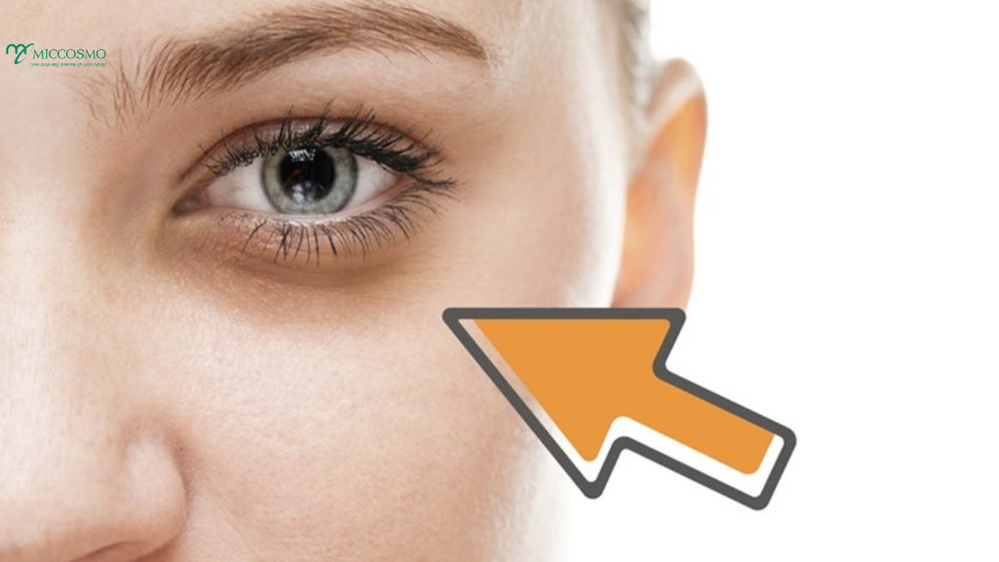 Top 4 cách làm mờ quầng thâm mắt được chuyên gia khuyên dùng